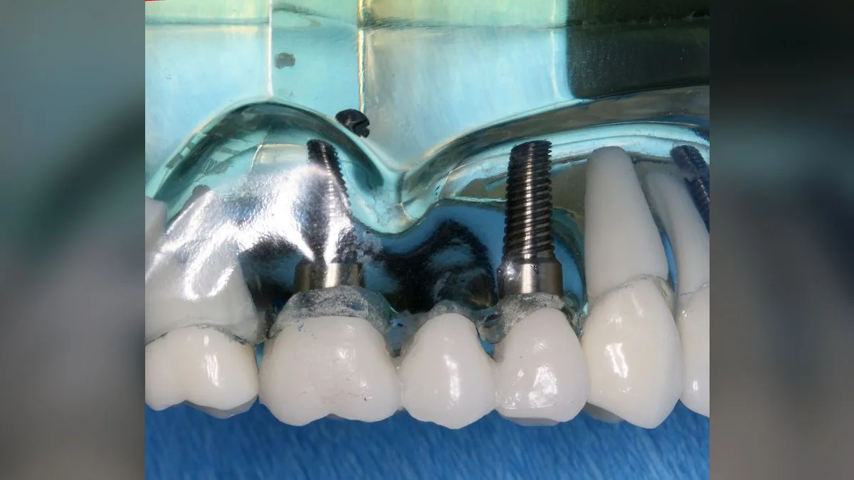 Dental Office 3D Printer Beside Printed Crown and Bridge Models using Formlabs Form 2 SLA
