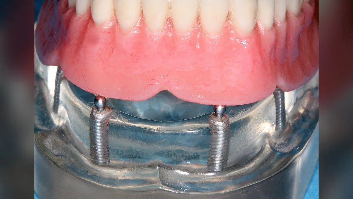 Dental Implant Model