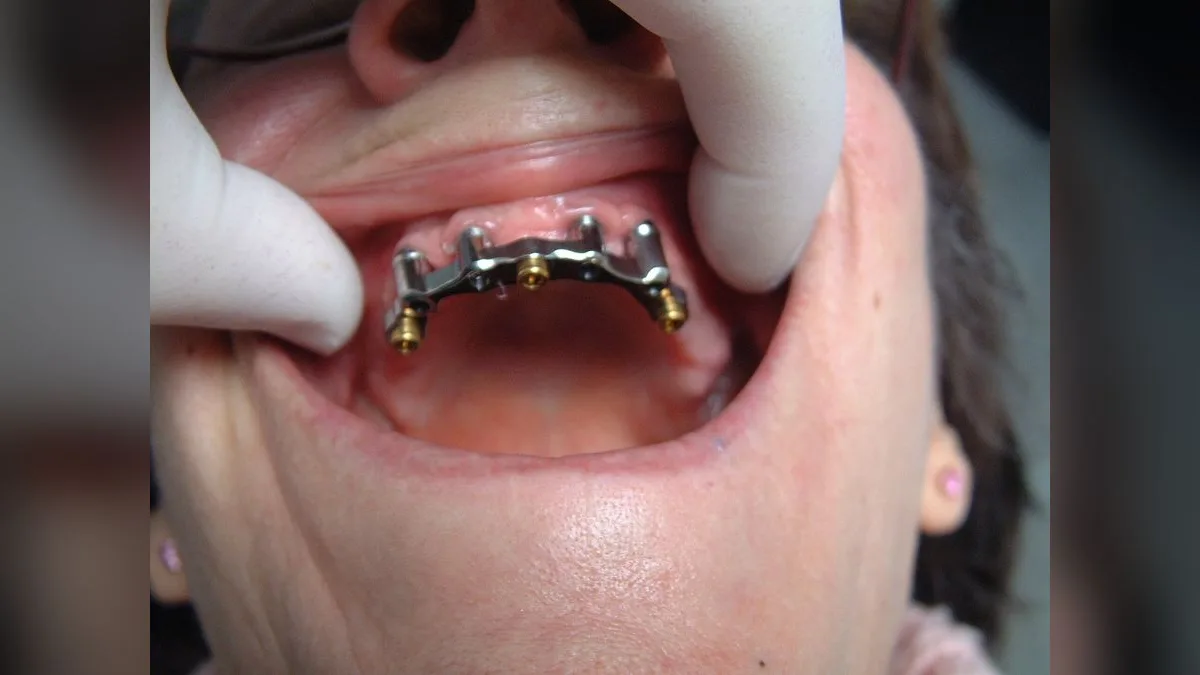 Dental prosthesis