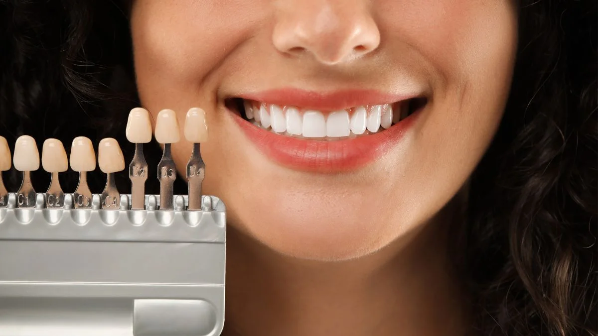 Guía de color comparada junto a la sonrisa de una paciente