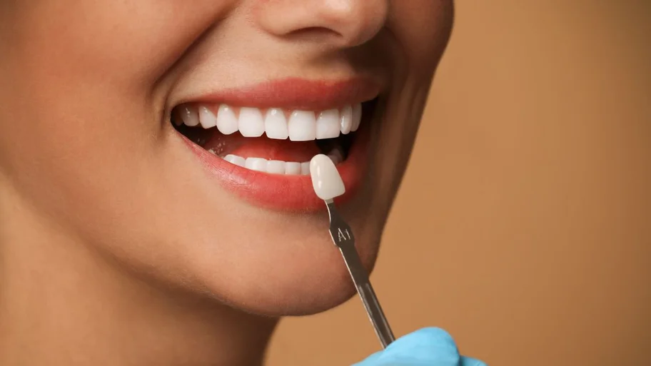 Prova de cor de uma faceta junto ao dente
