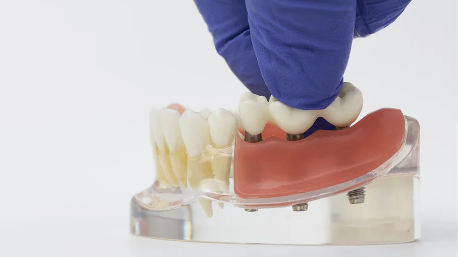 Modelo con prótesis sobre implantes