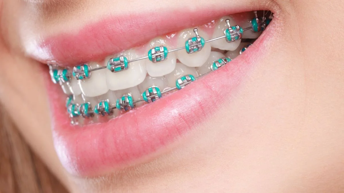 Sorriso com aparelho ortodôntico estético
