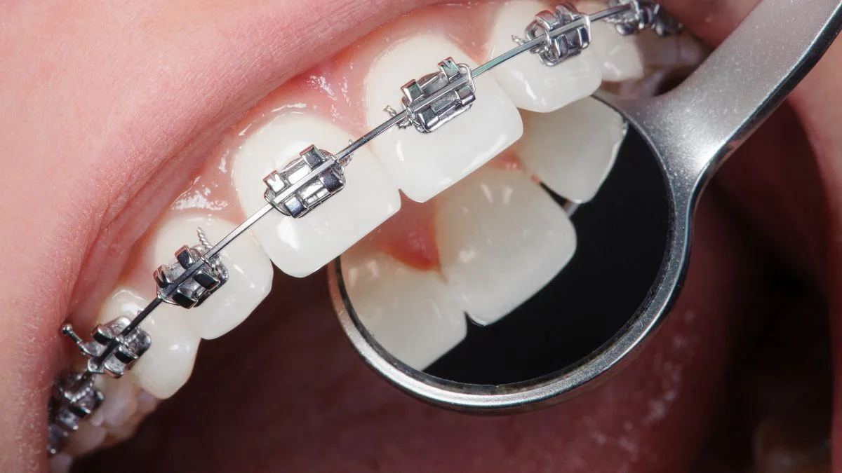 Controle ortodôntico com espelho intrabucal