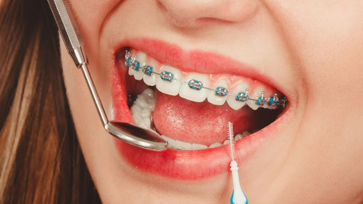 Limpeza entre os braquetes com escova interdental