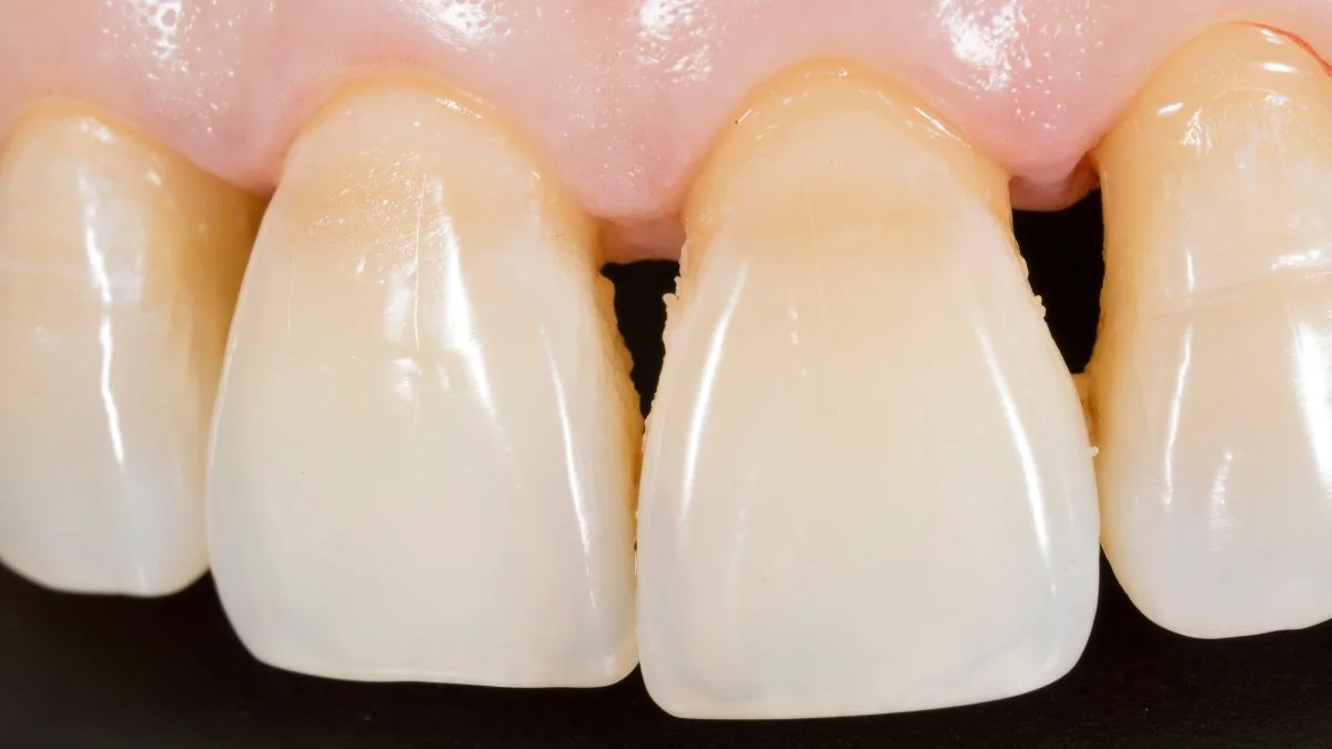 Primer plano de encías y dientes durante una revisión