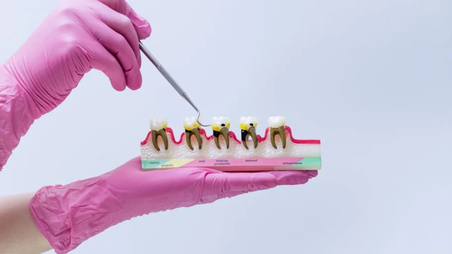 Modelo periodontal sostenido en la mano